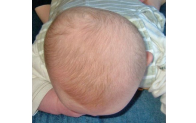 Esta foto mostra de cima a cabeça de um bebê com plagiocefalia